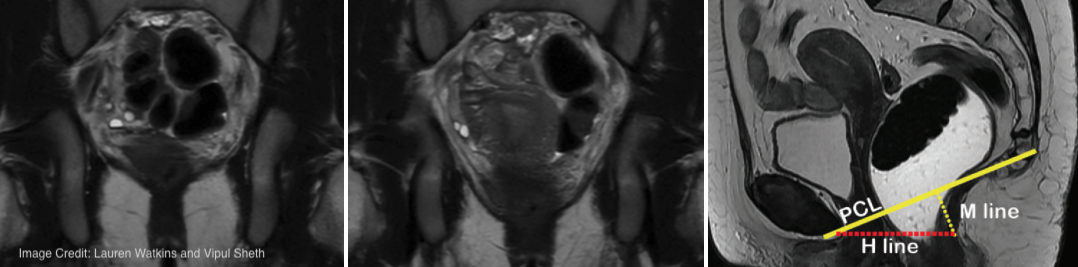 MRI image of sustained msucle contraction.